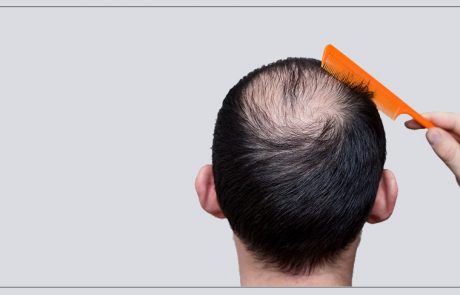 השתלת שיער לגבר
